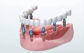 The Ultimate Guide to Dental Implants: Everything You Need to Know!