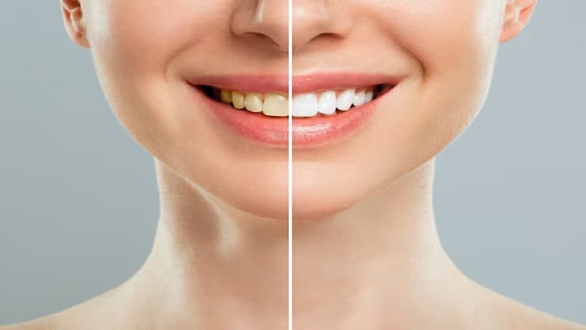 Restore Confidence and Functionality with Dentures in Huntington Beach