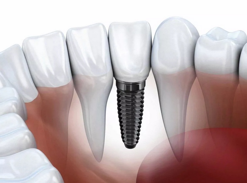 Experience the Benefits of All-on-4 Dental Implants in San Diego