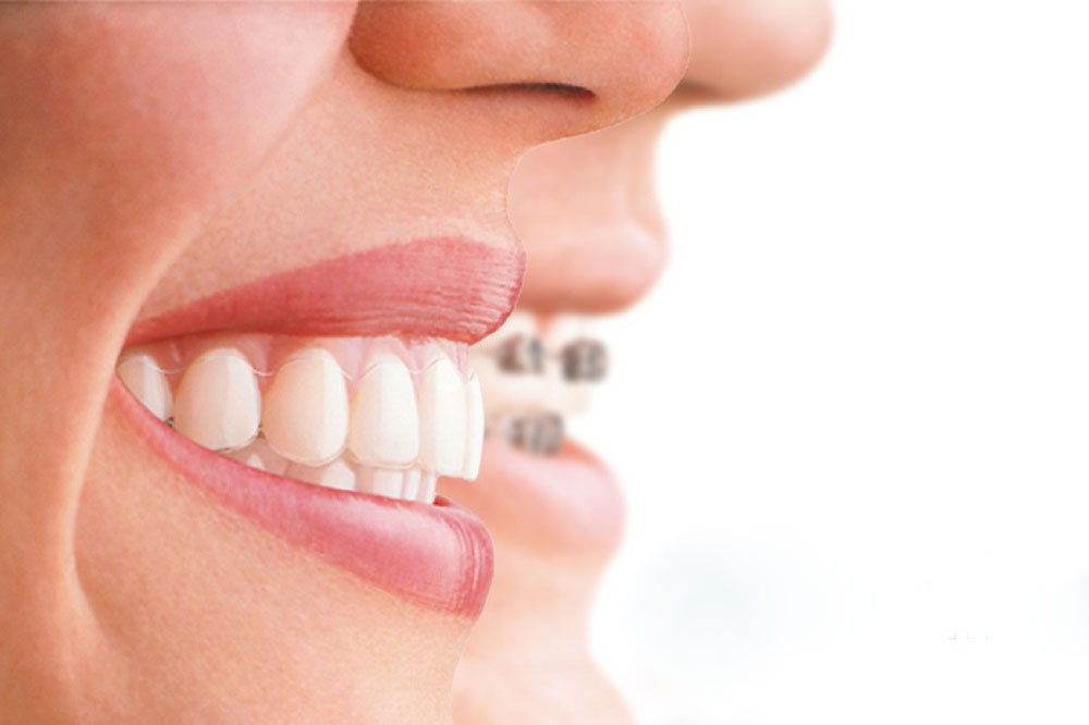 Aligners with invisible braces are best for adults