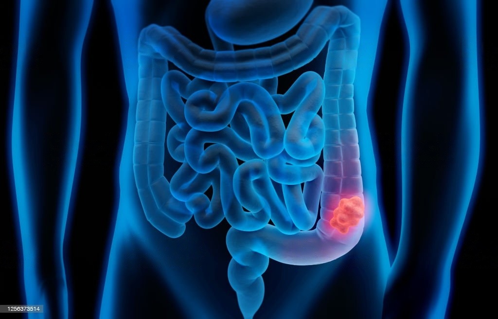 How long does a colonoscopy take, what is it, & how is it done?