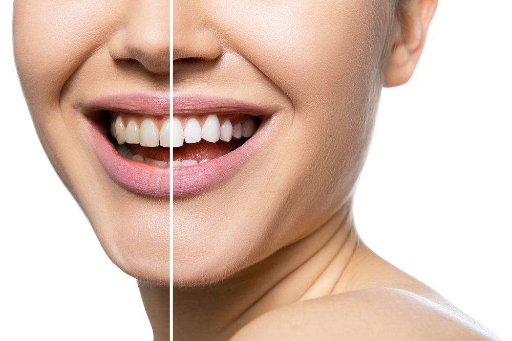 What Do Dentists Advise for Whitening Teeth?
