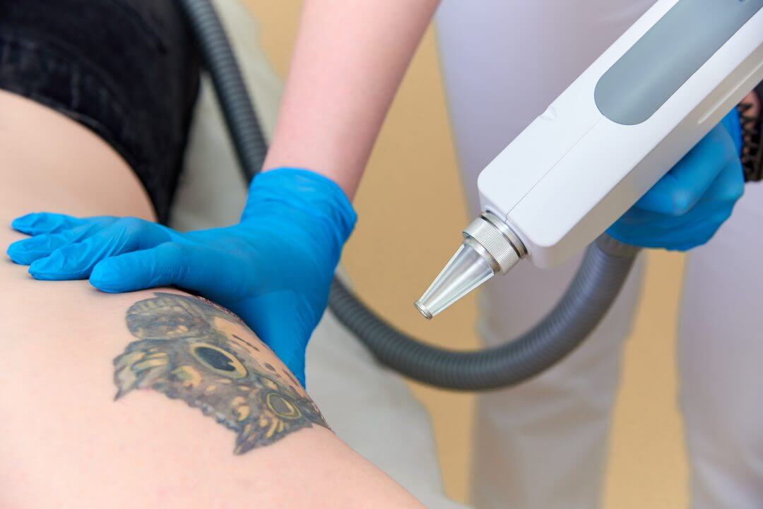 Laser tattoo removal post-treatment care