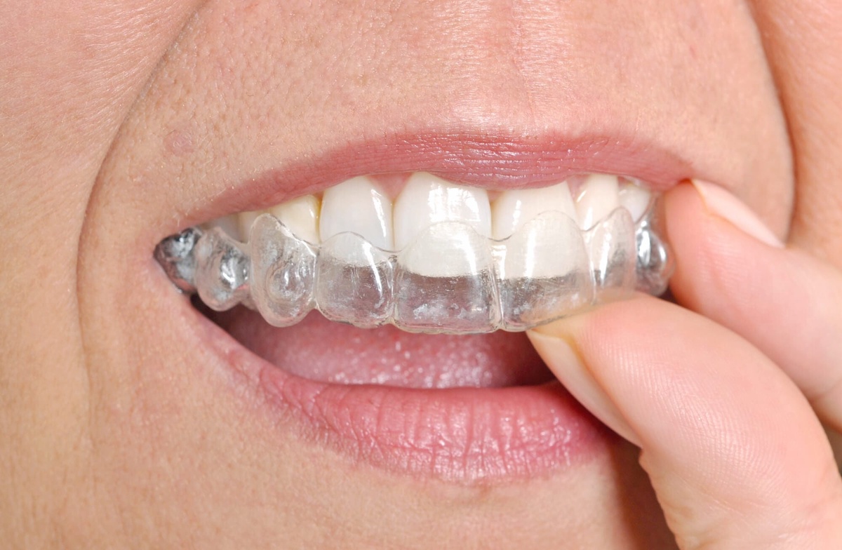 Transform your smile with Braces