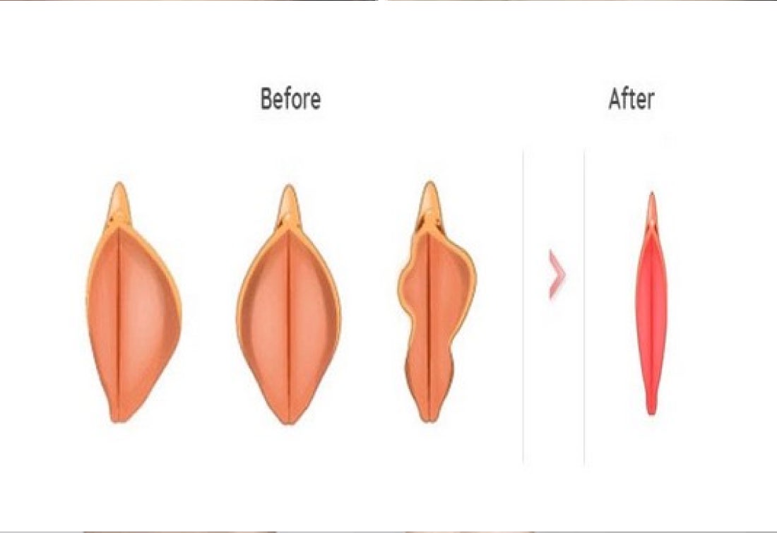What Are The Vital Things To Know About The Vaginal Reconstruction Surgery