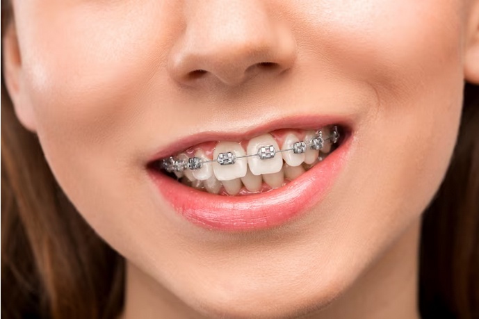 Unlocking Smiles: The Ultimate Guide to Lingual Braces