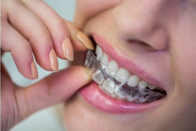 Smile Confidently with Lingual Braces: A Hidden Way to Straighten Teeth