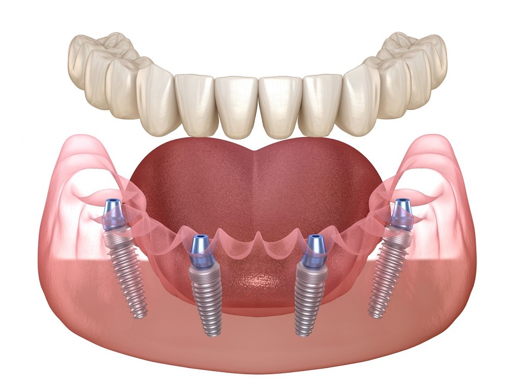 Dental Implants in Roslyn: A Guide to a Lasting Smile