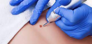 Why Is Skin Tag Removal Necessary in Dubai?