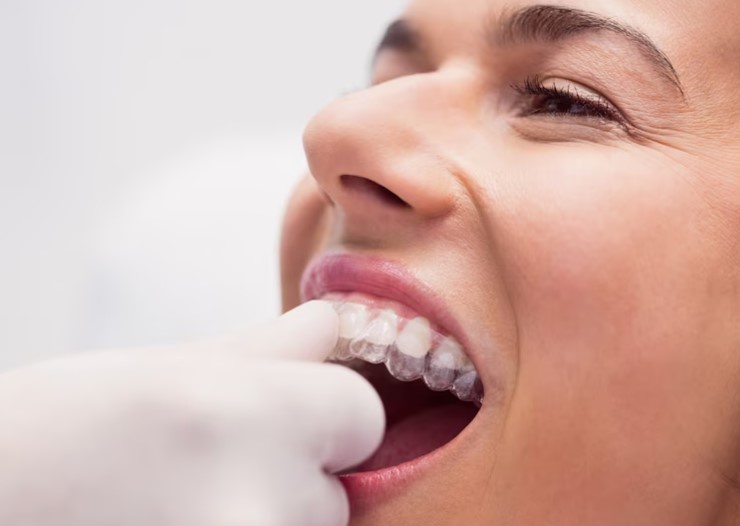 Advancements In The Technology Of Invisalign Treatment