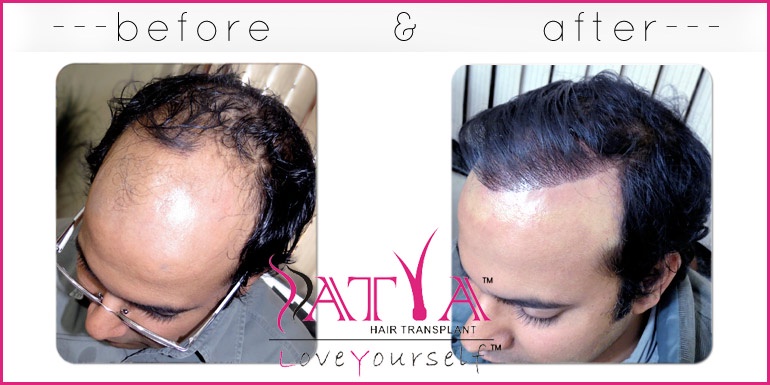 Discover the Best Hair Transplant Clinic in the USA: Satya Hair Solutions