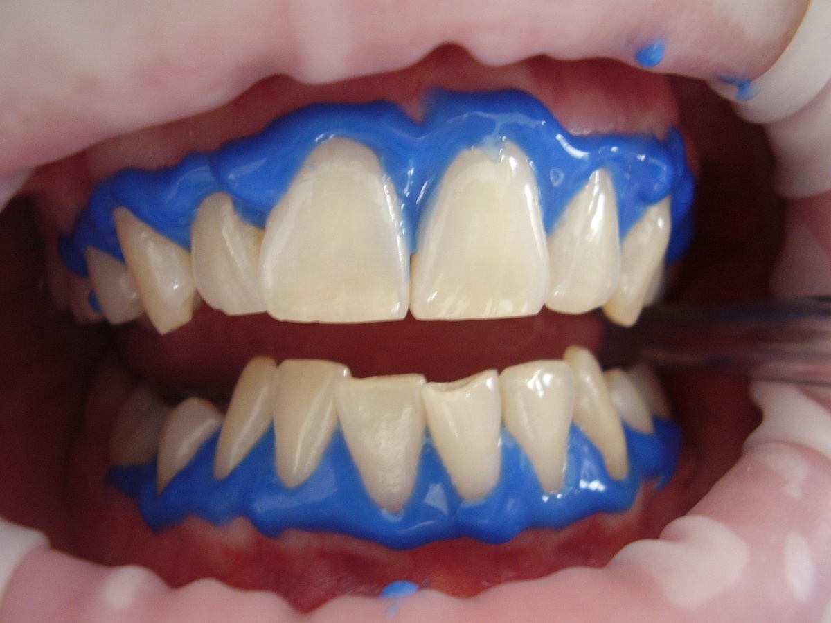 Demystifying the Top 5 Misconceptions Surrounding Teeth Whitening and Providing Insight into Frequently Asked Questions