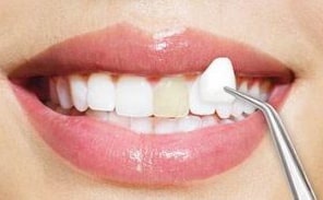 Dental Veneers Can Correct Dental Imperfections and Boost Your Confidence