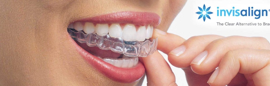 How to Clean and Care for Your Invisalign Aligners