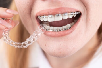 Choosing the Right Orthodontic Option: Aligners or Braces?
