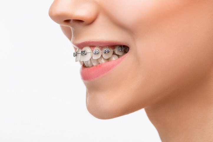 Brace Yourself for a Perfect Smile: Navigating Traditional Braces in Columbus, Ohio