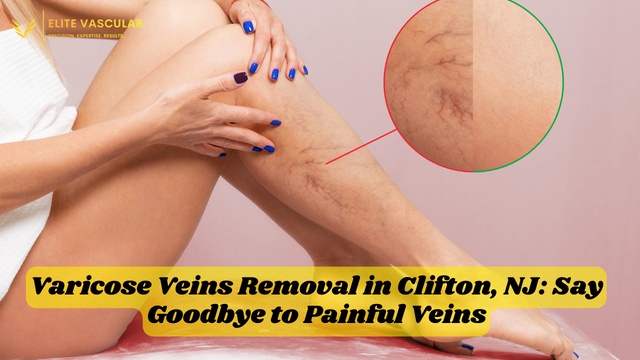 Varicose Veins Removal in Clifton, NJ: Say Goodbye to Painful Veins