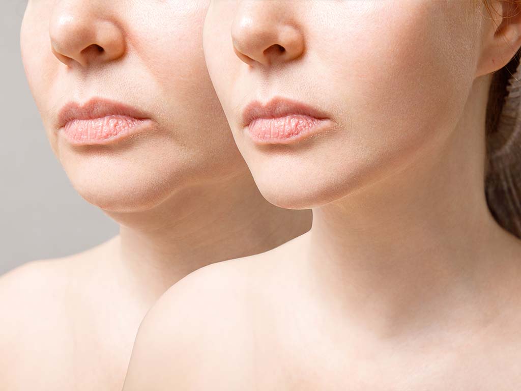 Experience the Wonders of Non-Surgical Rejuvenation with Dermal Fillers