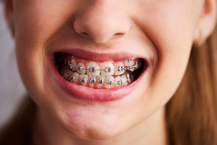 Straight Talk: The Ultimate Guide to Traditional Braces in Columbus