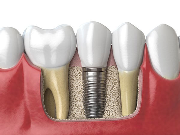 Things you must know about implant dentistry