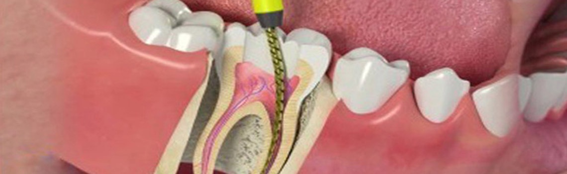 Painless Microscopic Root Canal in Delhi
