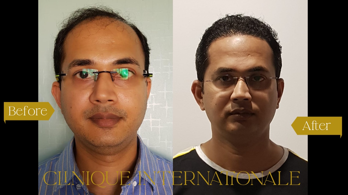 Achieving Natural-Looking Hair Restoration: The Quest for the Best Hair Transplant