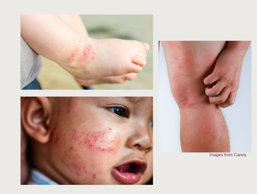 Eczema (Atopic Dermatitis) in Children: A Parent's Comprehensive Guide