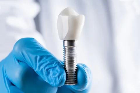 Reasons to Consider Professional Dental Implants for Single Tooth Replacement
