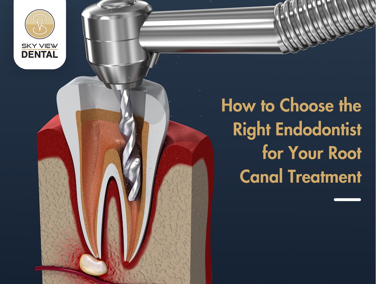 How To Choose the Right Endodontist for Your Root Canal Treatment