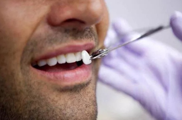 Dental Veneers Help to Enhance Your Appearance by Camouflaging Cosmetic Flaws