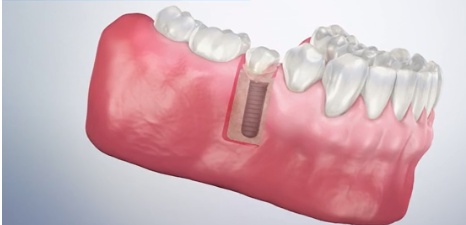 What should you know about the dental implants?