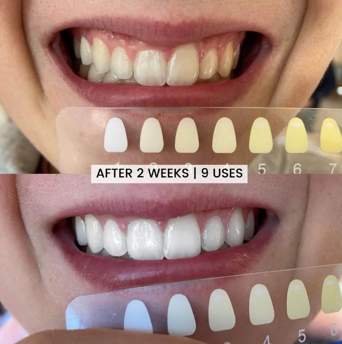 Transformative smile with the latest product of teeth whitening company