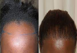 Hair Transplantation for Afro-Textured Hair: What to Expect