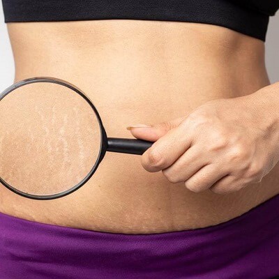 What to Expect During and After Laser Stretch Marks Removal