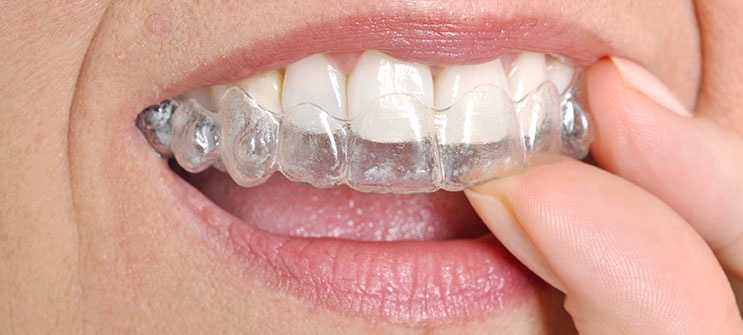 Get Your Dream Smile! Why Hillsboro Dental's Invisalign Service is Unmatched