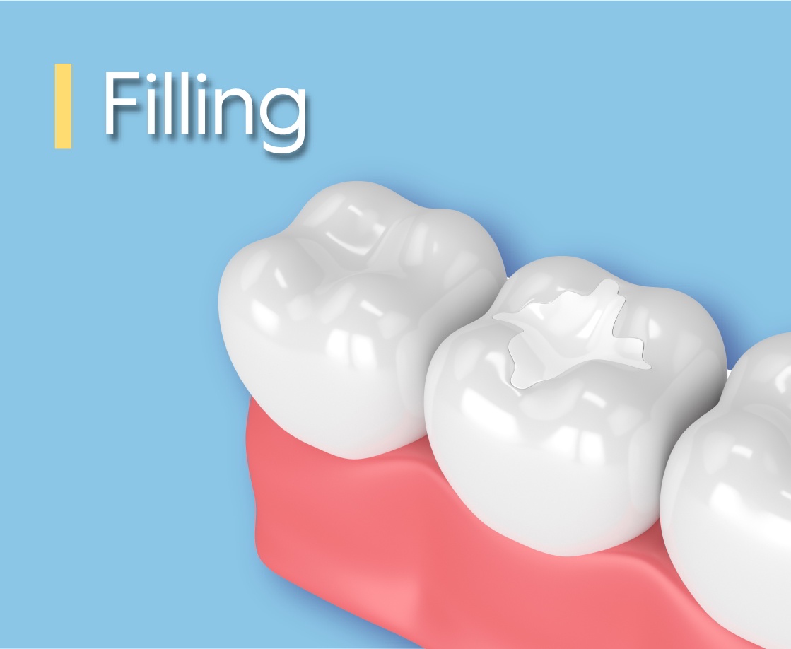 Choosing the Best Tooth Filling: A Guide for Indian Land Residents