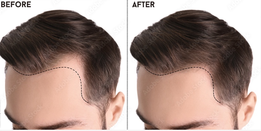 Different Ways to Stimulate Hair Growth for Men in 2023