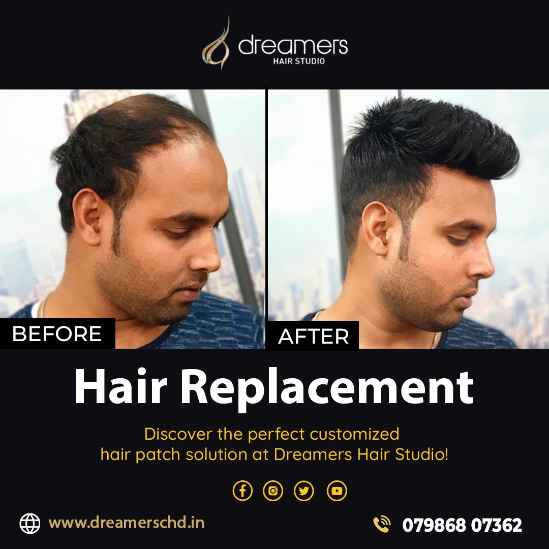 Transforming Lives with Innovative Hair Replacement Solutions in Chandigarh,Panchkula and Mohali - Dreamers Hair Studio
