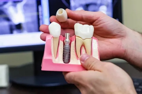 Dental Implant Benefits: Beyond Aesthetics, Improving Oral Health