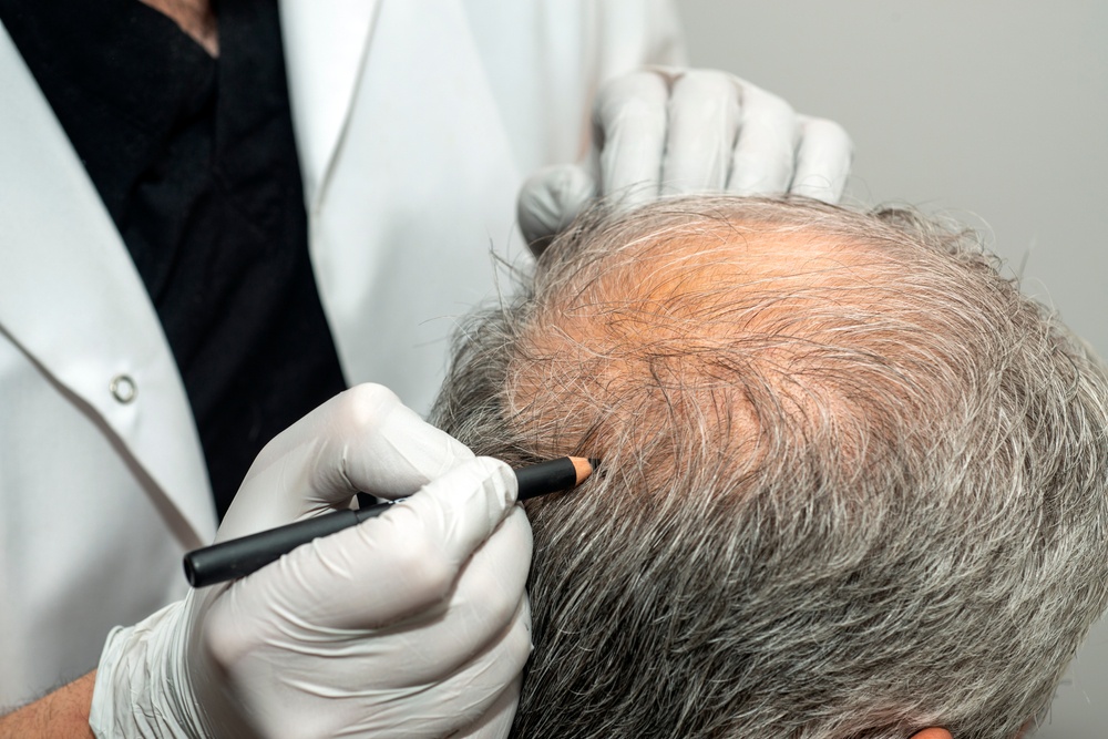Regaining Confidence: PRP Hair Treatment for Receding Hairline