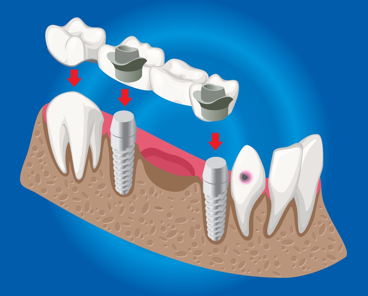 Get A Full Set of Teeth in One Day With All-on-4 Dental Implants