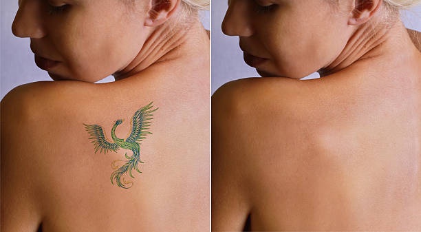 "Erasing the Past: The Power of Laser Tattoo Removal"