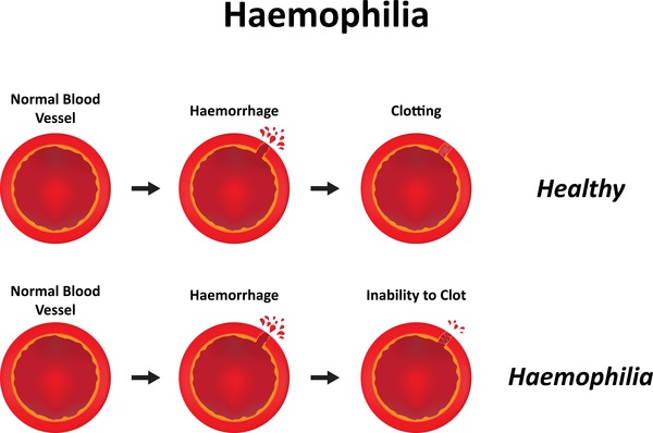 Hemophilia: A Journey from Diagnosis to Hopeful Treatments