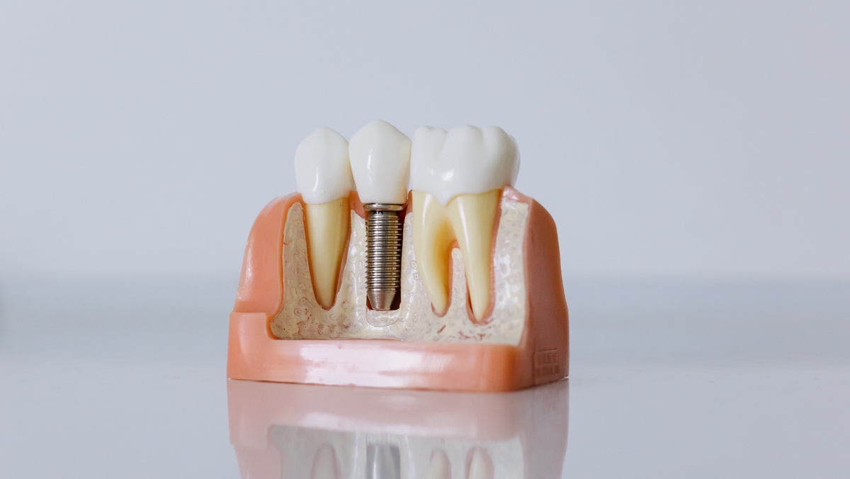Recognizing the Differences Between Dental and Denture Implants