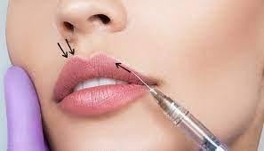 Russian Lips: The Trending Lip Filler Technique