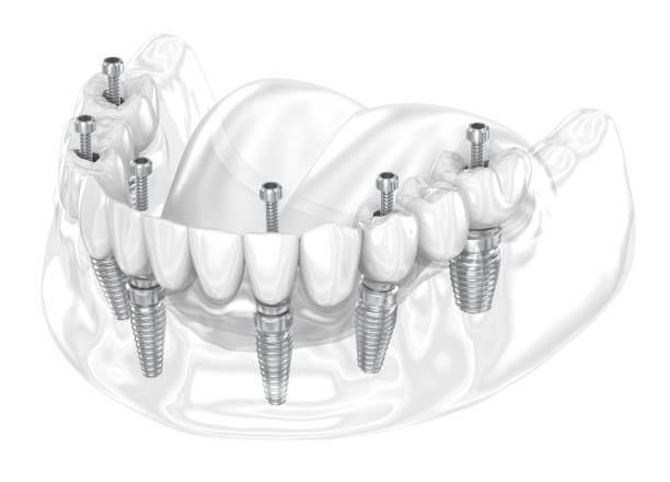 Dental Implants Unveiled: Riyadh's Transformative Dental Solutions