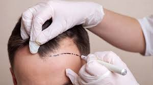 Rooted in Renewal: The Latest Trends in Hair Transplant in Riyadh