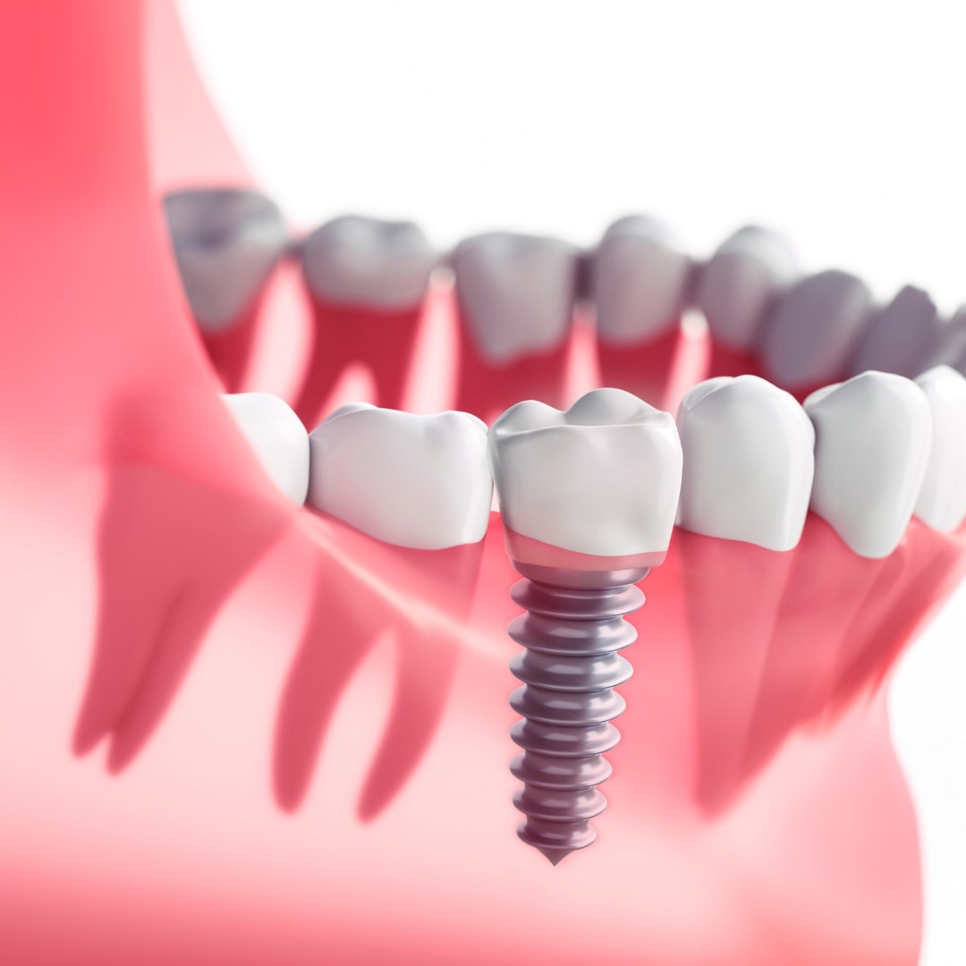 How to opt for affordable dental implants in coimbatore?