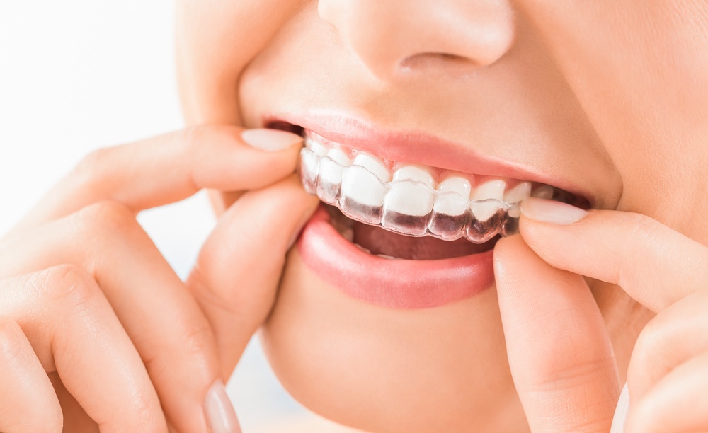Invisalign in Clermont: Straightening Smiles with Modern Precision