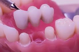 Dental Implants Pros and Cons